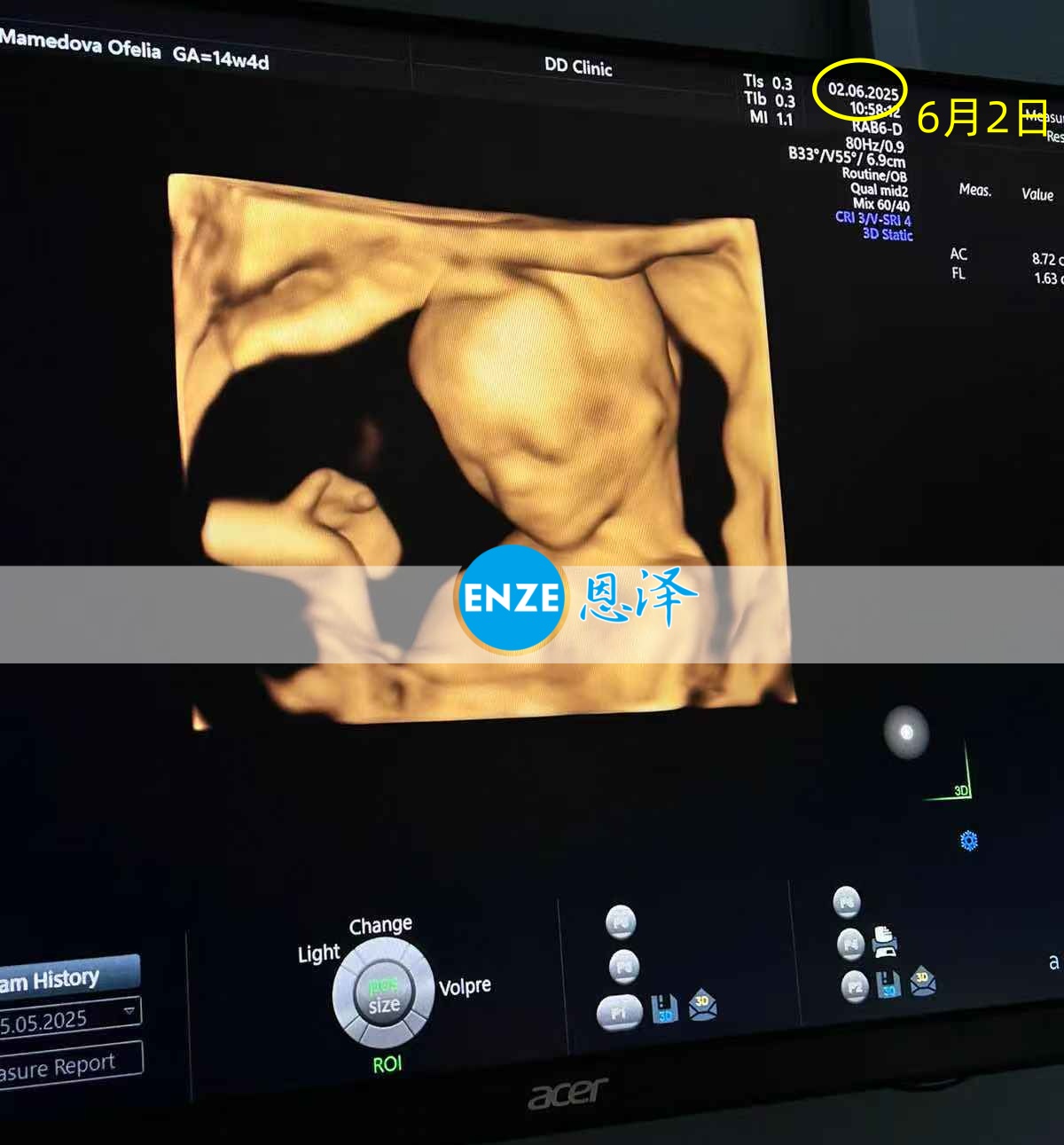 恩泽格鲁吉亚代孕代母14周检查顺利通过