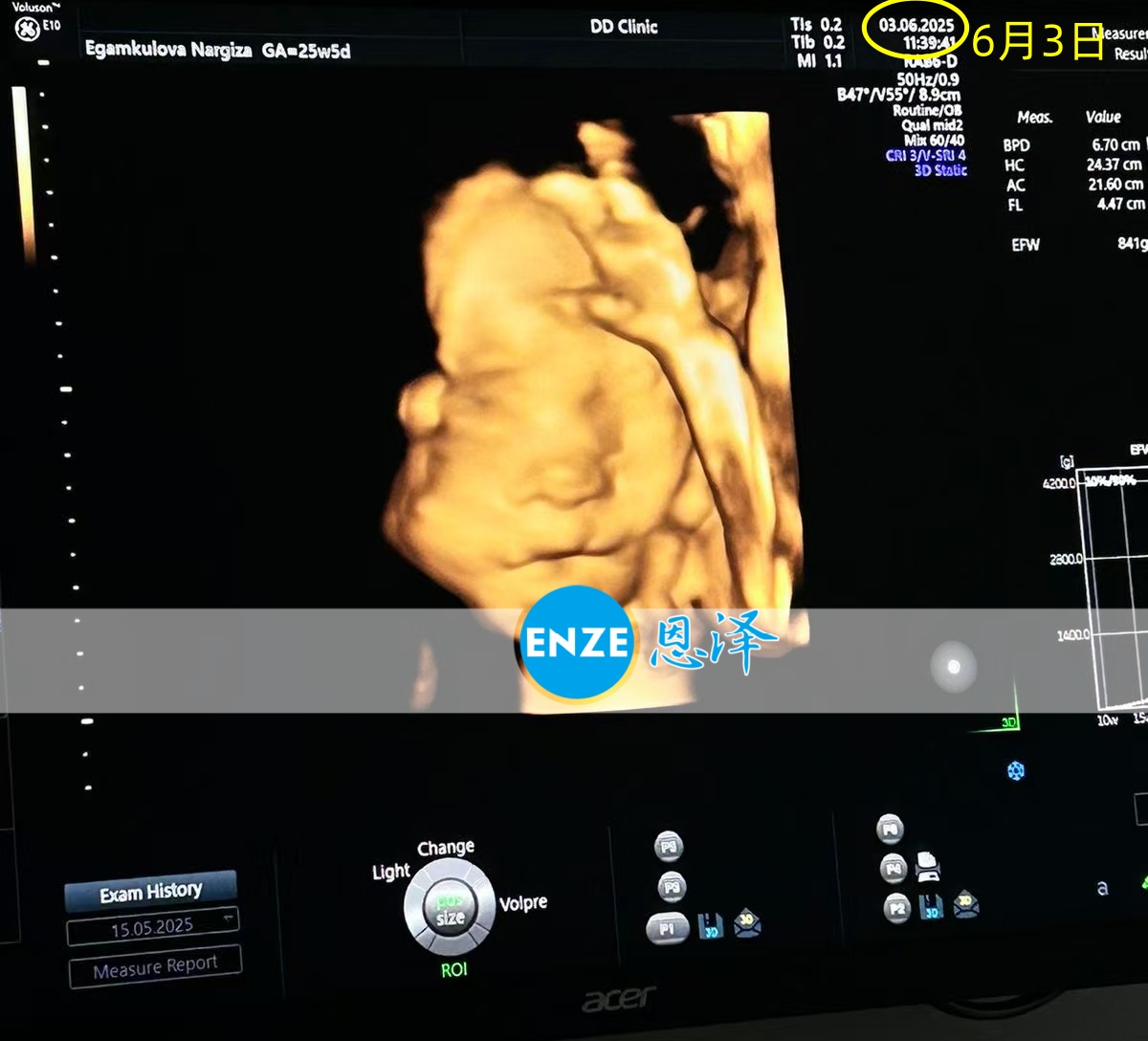 恩泽格鲁吉亚代孕代母25周检查顺利通过