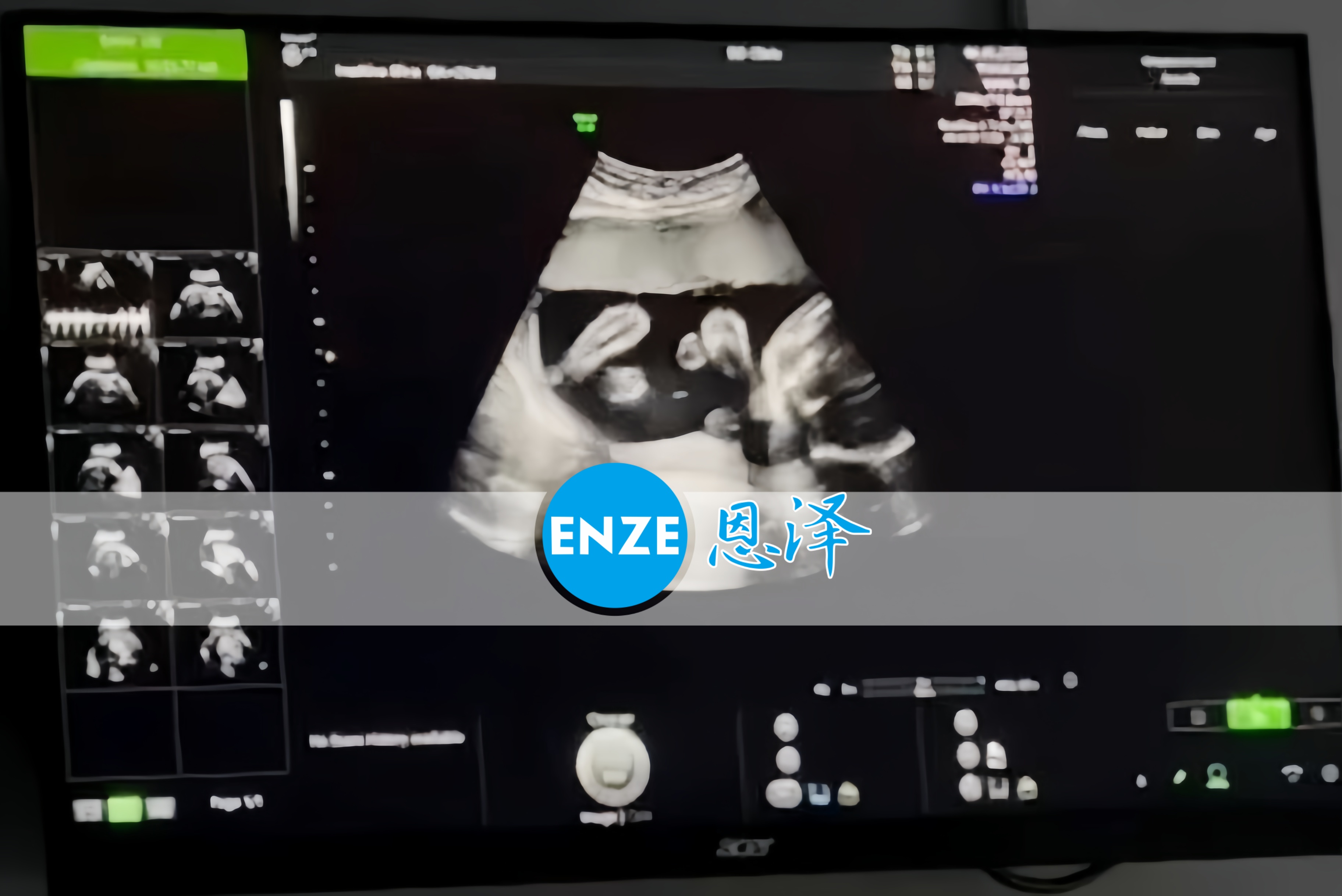 恩泽格鲁吉亚代孕代母21周检查顺利通过