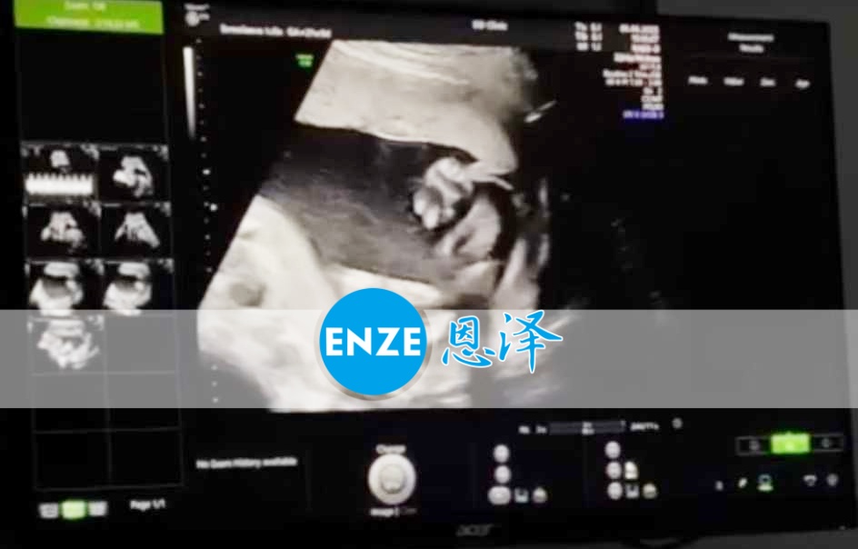 恩泽格鲁吉亚代孕代母21周检查顺利通过