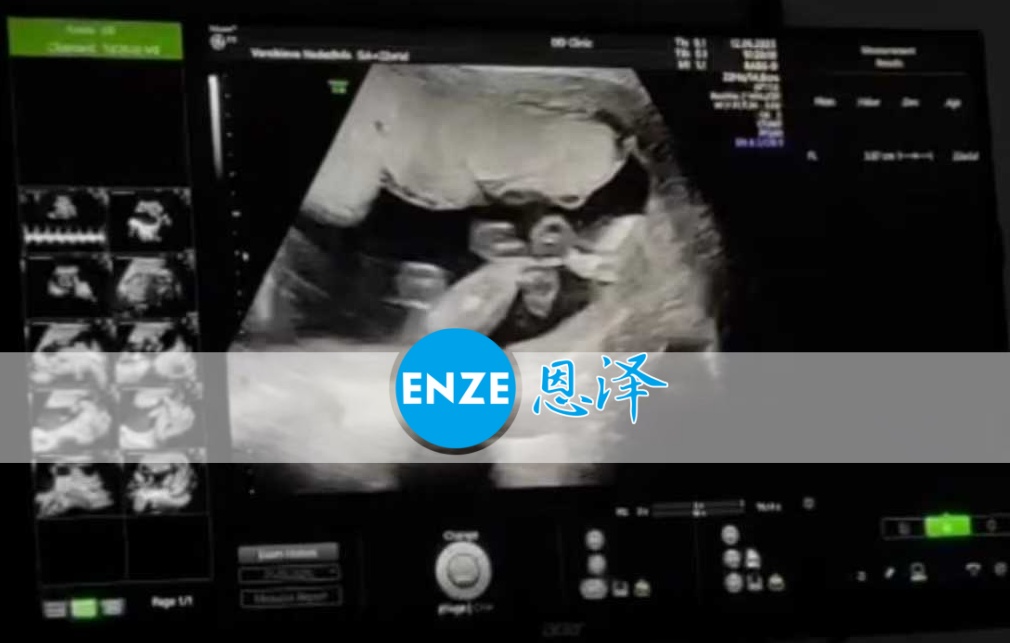 恩泽格鲁吉亚代孕代母22周检查顺利通过