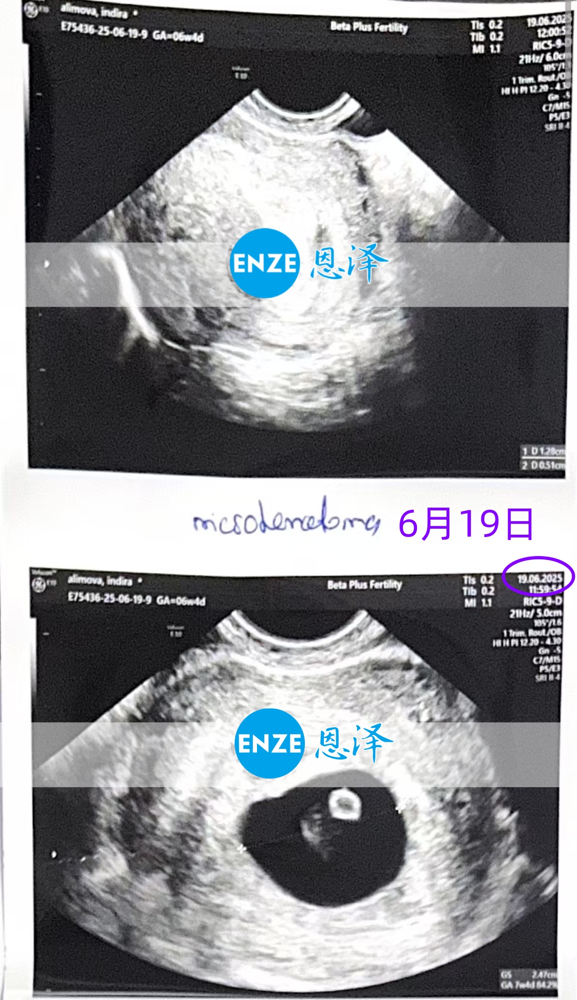 恩泽格鲁吉亚代孕代母6周检查顺利通过