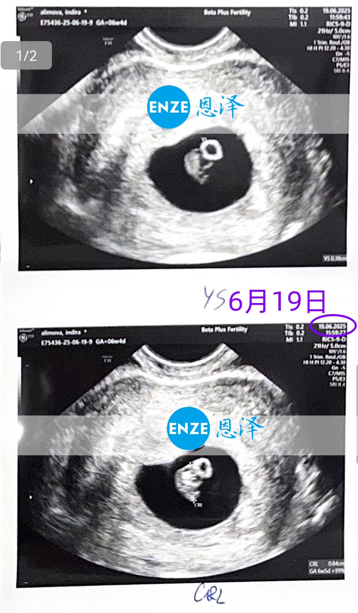 恩泽格鲁吉亚代孕代母6周检查顺利通过