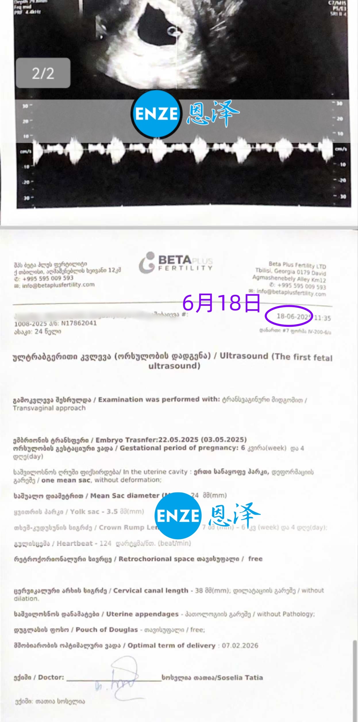恩泽格鲁吉亚代孕代母6周检查顺利通过