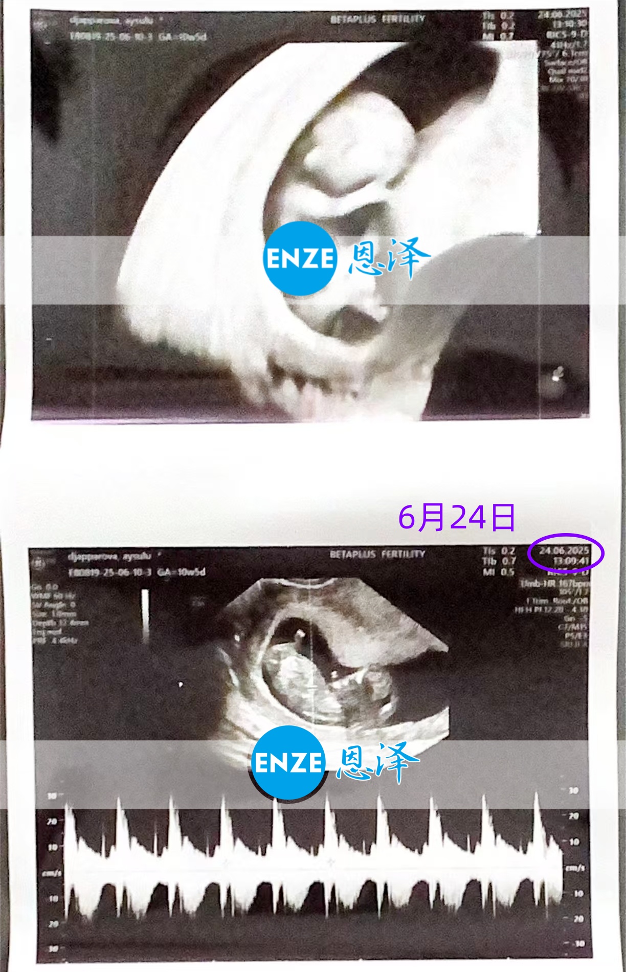 恩泽格鲁吉亚代孕代母10周检查顺利通过