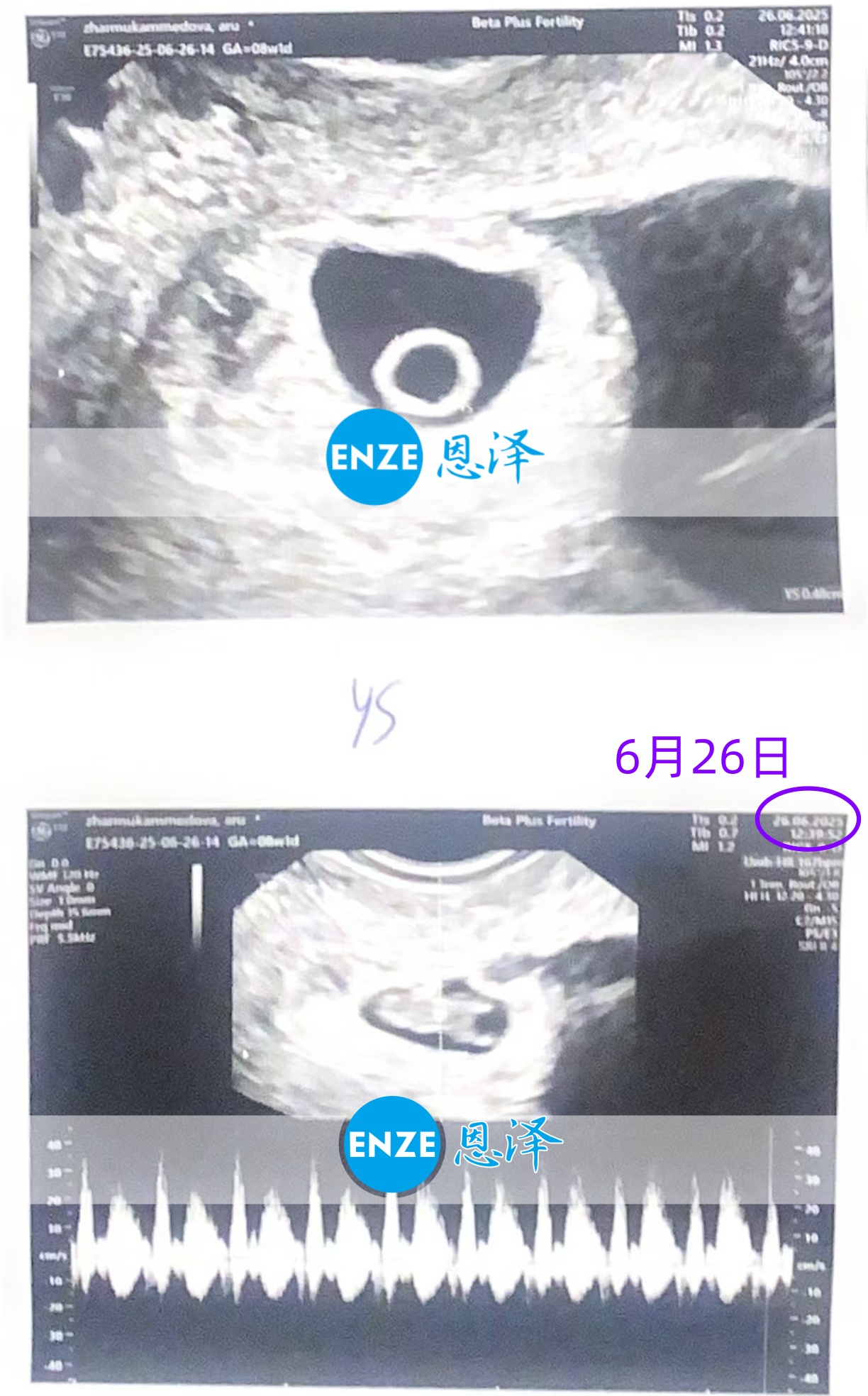 恩泽格鲁吉亚代孕代母8周检查顺利通过
