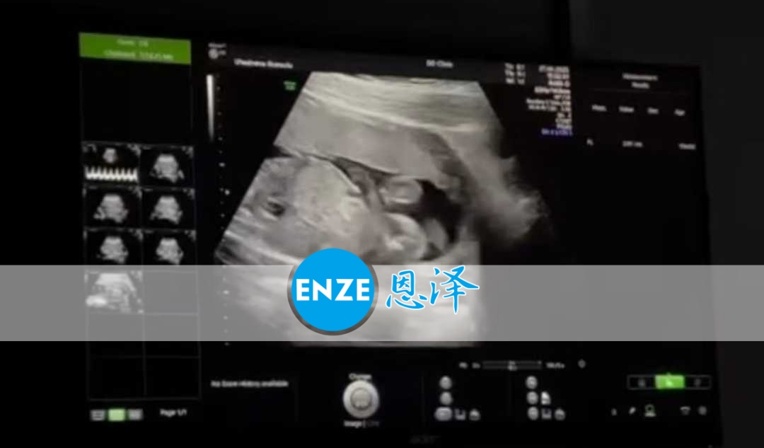 恩泽格鲁吉亚代孕代母19周检查顺利通过