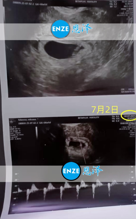 恩泽格鲁吉亚代孕代母6周检查顺利通过