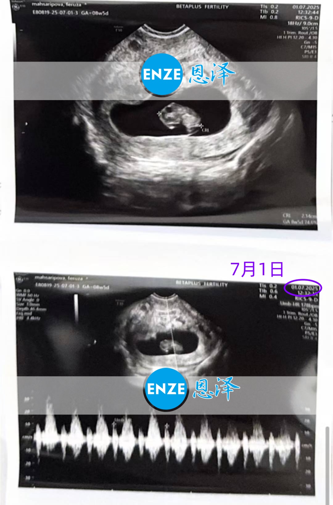 恩泽格鲁吉亚代孕代母8周检查顺利通过