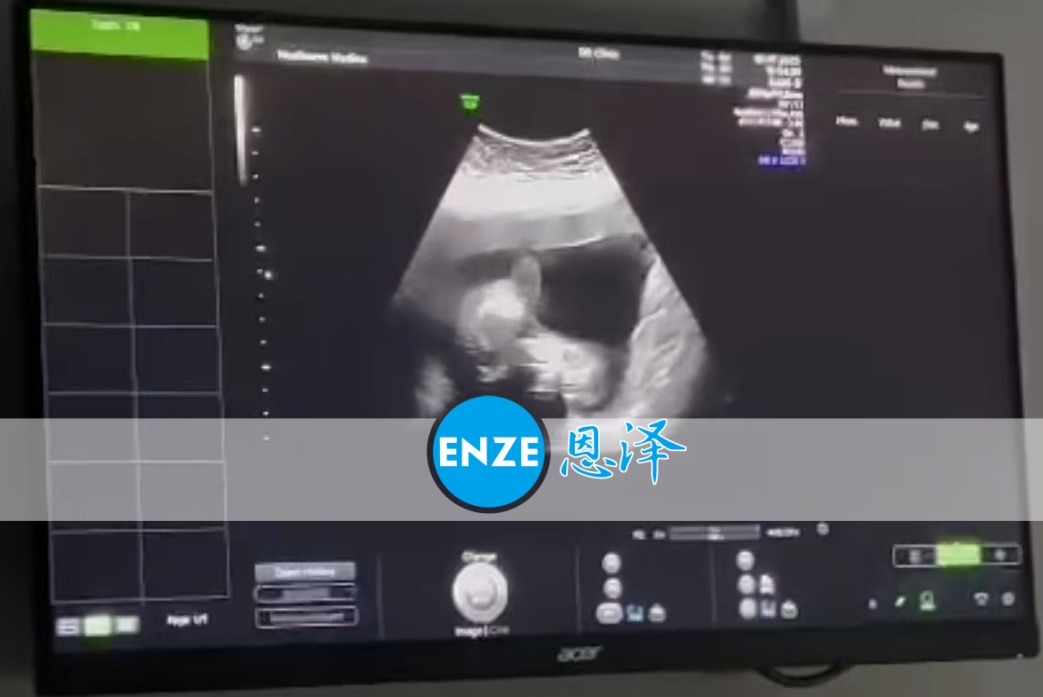 恩泽格鲁吉亚代孕代母19周检查顺利通过
