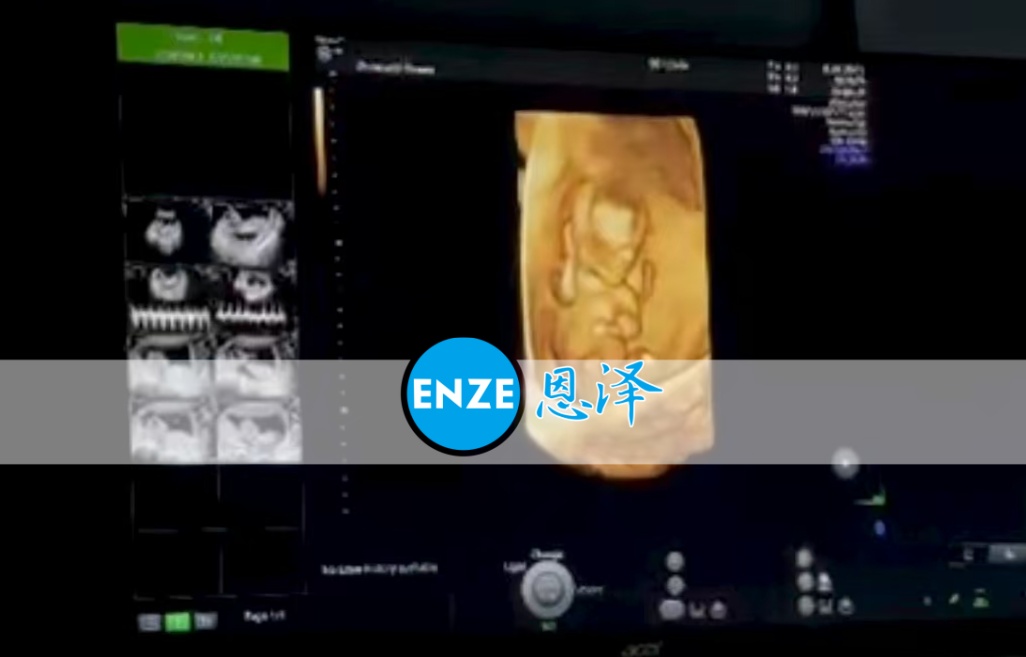 恩泽格鲁吉亚代孕代母13周检查顺利通过