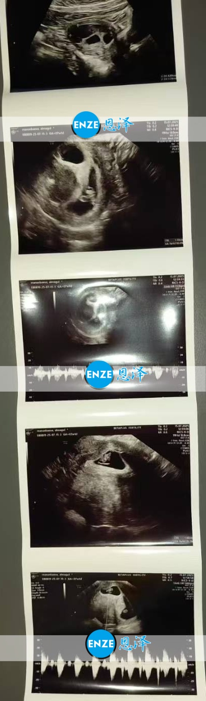 恩泽格鲁吉亚代孕代母7周检查顺利通过