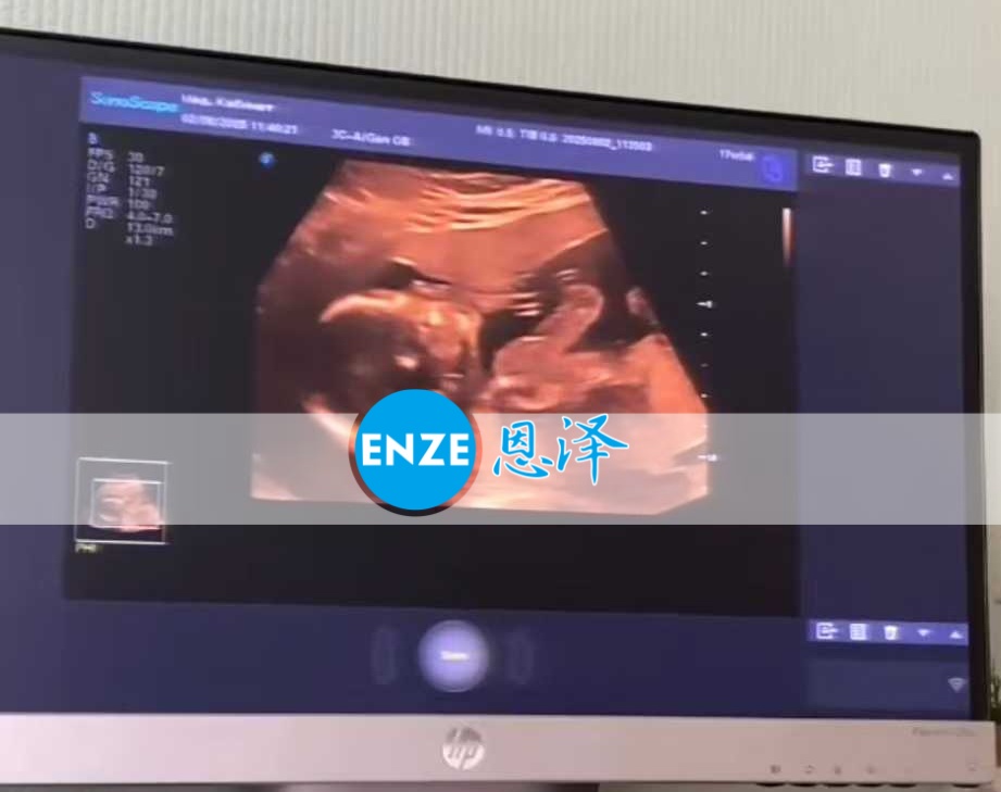 恩泽格鲁吉亚代孕代母18周检查顺利通过