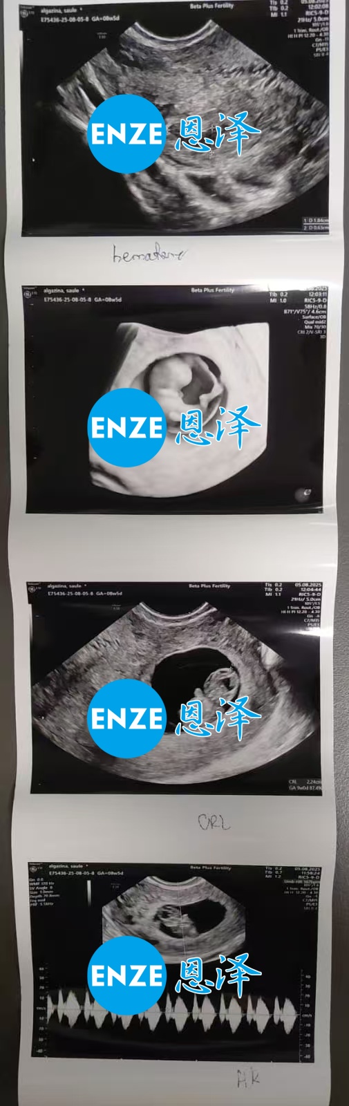 恩泽格鲁吉亚代孕代母8周检查顺利通过