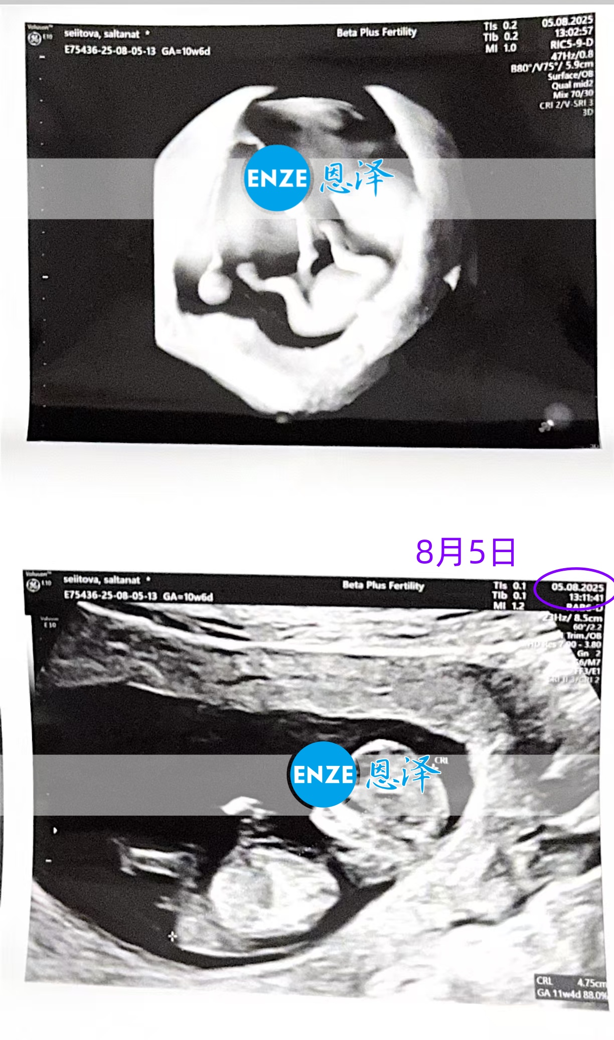恩泽格鲁吉亚代孕代母10周检查顺利通过