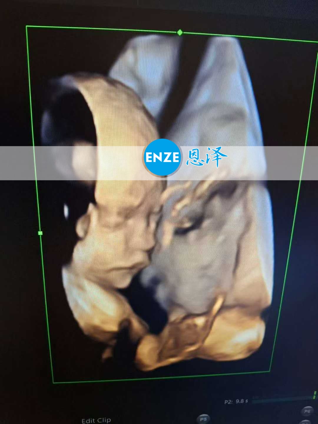 恩泽乌克兰代孕代母24周检查顺利通过