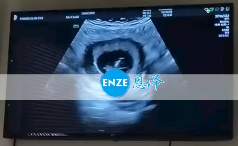 恩泽格鲁吉亚代孕代母10周检查顺利通过