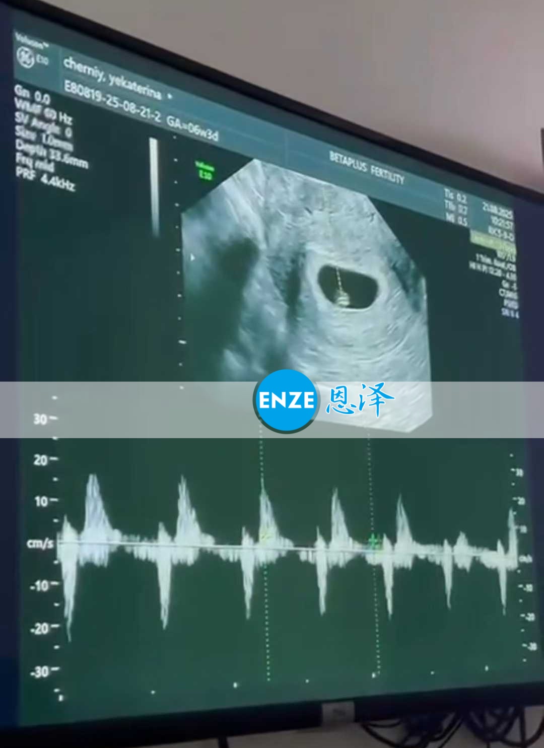 恩泽格鲁吉亚代孕代母21周检查顺利通过