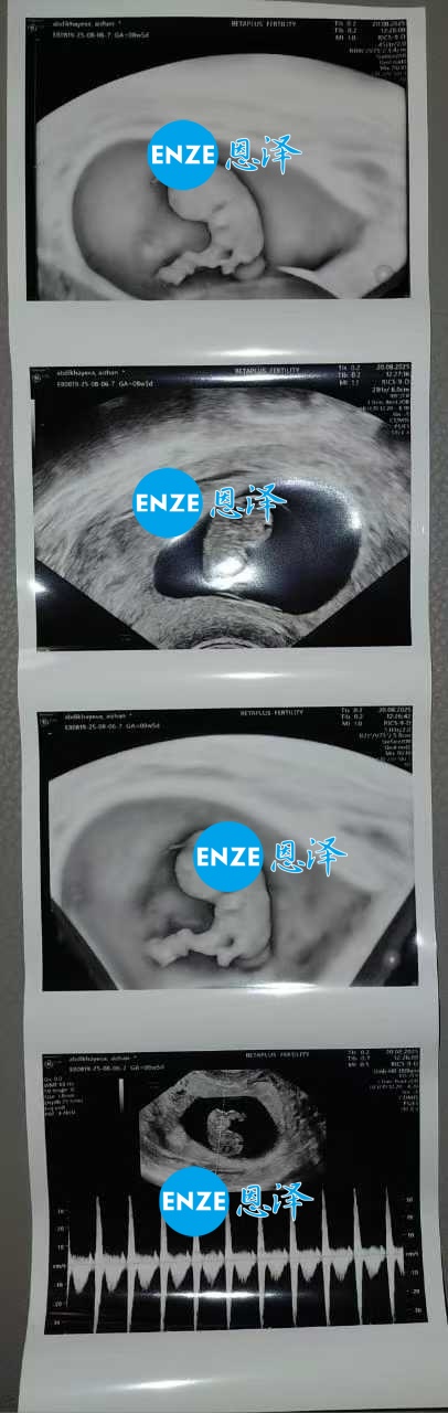 恩泽格鲁吉亚代孕代母8周检查顺利通过