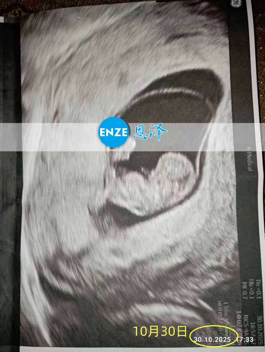 恩泽乌克兰代孕代母9周检查顺利通过