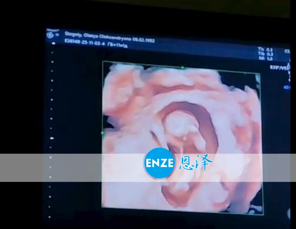恩泽乌克兰代孕代母11周检查顺利通过